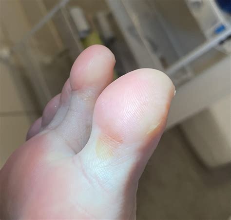 Is this nail fungus? Noticed orange stains on big toe : r/NailFungus