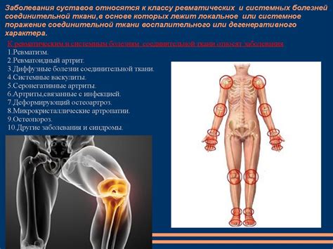 Болезни суставов и соединительной ткани - презентация онлайн
