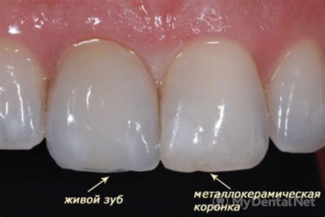 Презентация Металлокерамические Коронки - andromedapap