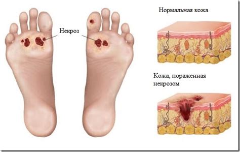 Виды и лечение некроза стопы