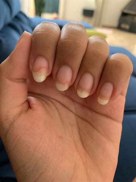 Index nail looks like this and I’m not sure why. I first thought I