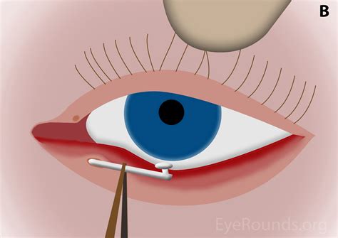 Lacrimal Punctum Diagram