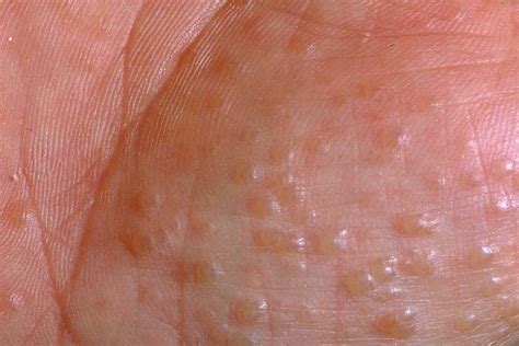 Dyshidrotic eczema | Symptoms, Causes, Treatment, and More - Pure Medical