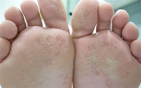 ¿Cómo tratar los hongos de los pies? - Foot and Body