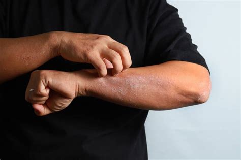 Eczema vs. Dry Skin | Cascade Eye & Skin Centers