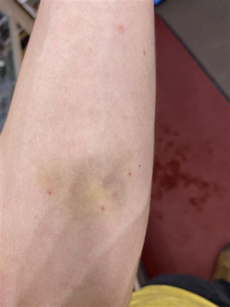 Cat Scratch Disease Rash