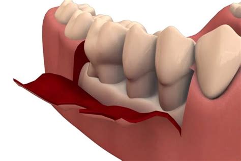 periodontal flap dr gourav sharma painless dental treatments
