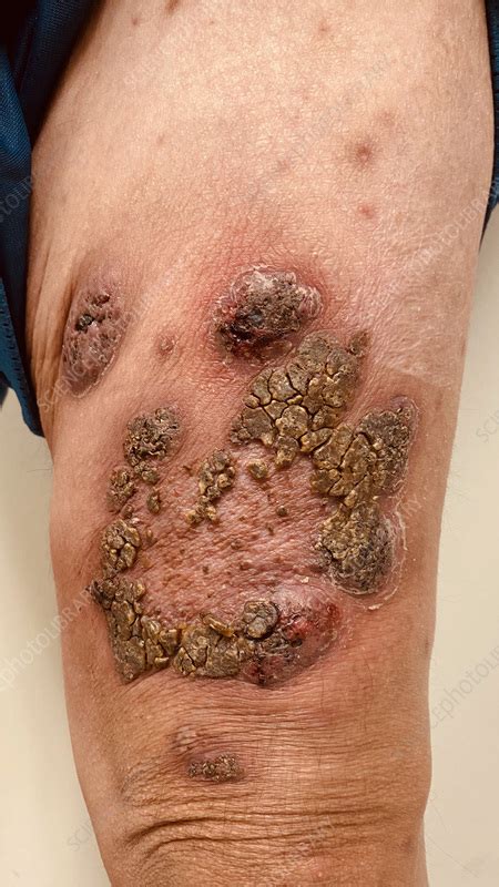 Pyoderma gangrenosum - Stock Image - C057/2266 - Science Photo Library
