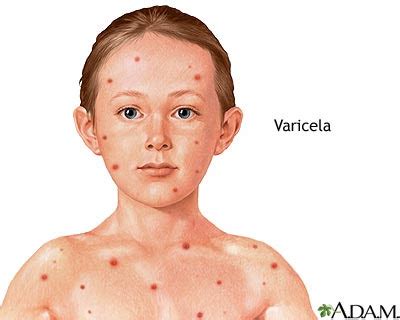 Creciendo con Amor: Varicela!!!!!!!