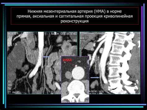 Мезентериальная ишемия