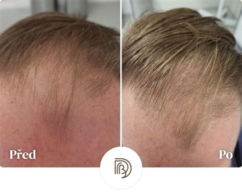 Minoxidil na předpis - tablety či sérum? - zkušenosti, vedlejší účinky