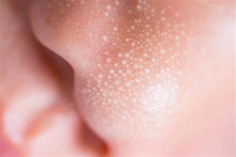 face rash  babies