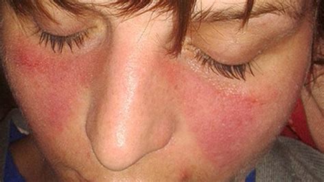 Systemic Lupus Erythematosus(SLE): Simptom, Punca dan Cara Rawatan
