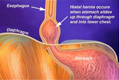 health website hiatus hernia
