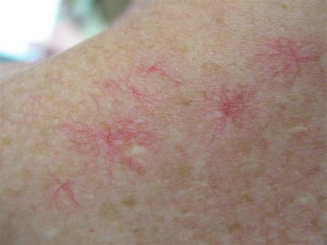 Симптомы токсического гепатита. "Сосудистые звездочки" (nevus araneus ...