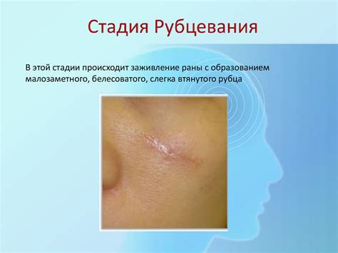 Фурункул, карбункул лица. Классификация, этиология, патогенез. Клиника ...
