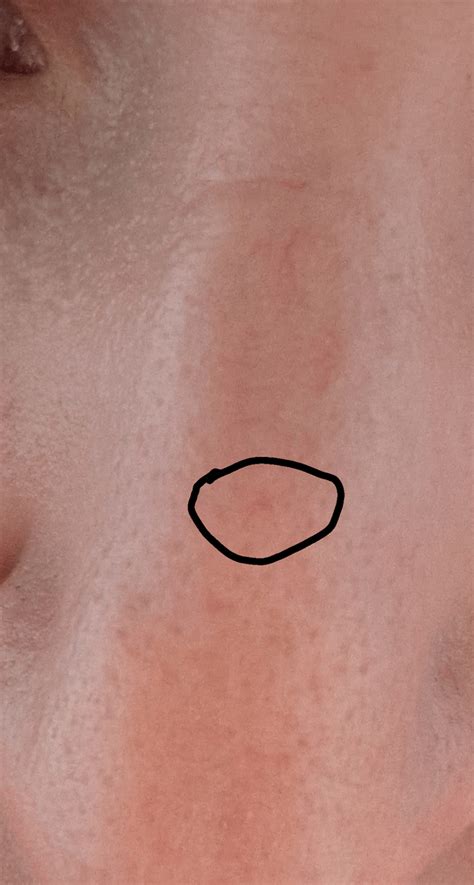 Spider Nevi??? Please look : r/AskDocs