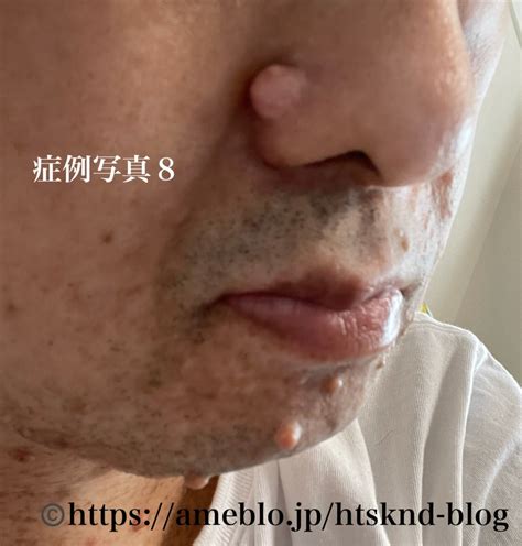 ep.25 痛みとレックリングハウゼン 〜顔はやめて〜 | 42歳、老人ホームに入所するも、8ヶ月で退所する
