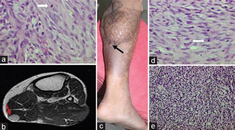 👉 Spindle Cell Sarcoma - Symptoms, Prognosis, Survival Rate, Treatment ...