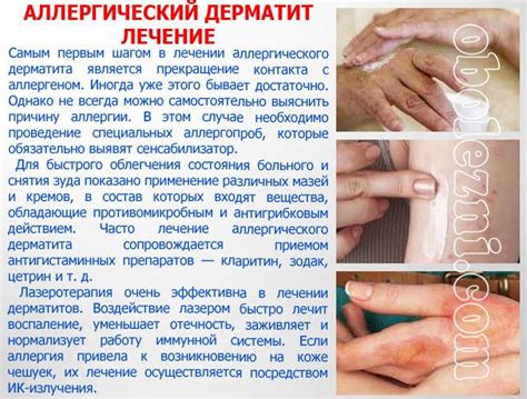 Самые эффективные мази от зуда и раздражения кожи