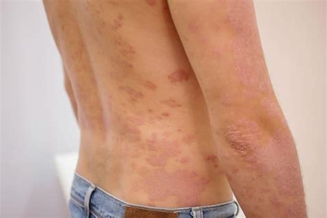 psoriasis eritroderma gejala penyebab pengobatan  sehat