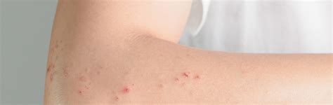 Shingles Treatment Fort Lauderdale FL - Shingles Rash Dania Beach FL