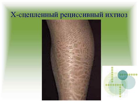 ИХТИОЗ. Ихтиоз представляет собой большую группу нарушений