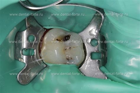 Лечение кариеса 26 зуба - Стоматология Набережные Челны - DENTAL FORTE ...