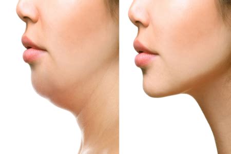 Meso Lipo (for Double Chin) – Subodha Skin Clinic