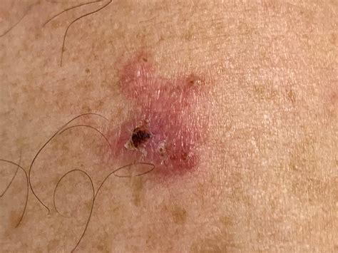 how to know if i have skin cancer