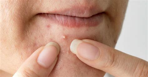 how to get rid of ingrown hair on chin women