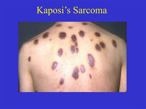 What Is A Kaposi Sarcoma