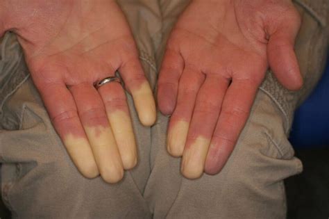 raynaud en acupunctuur bu ming acupunctuur