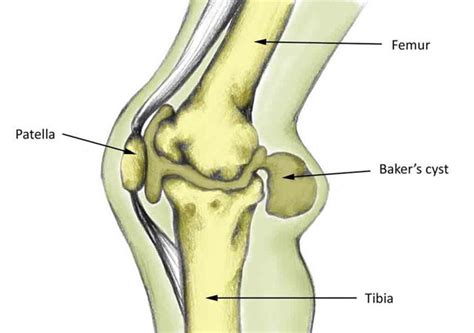 Baker's Cyst - Symptoms, Causes, Treatment and Rehabilitation