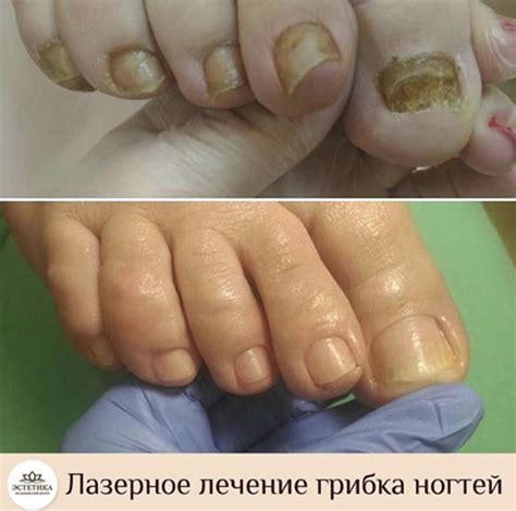 Лечение грибка ногтей на руках и ногах в Чебоксарах: фото и цены
