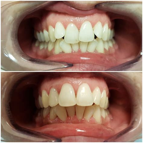 Clear Braces Gallery | Bespoke Dental Care - Gravesend