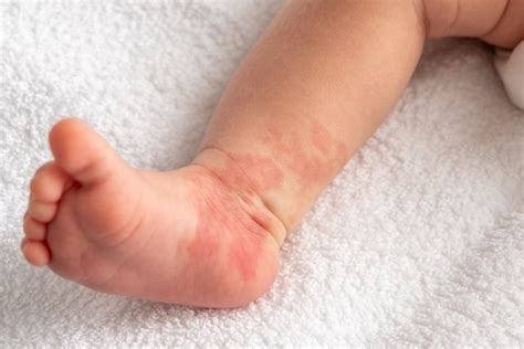 Infantile hemangioma: what it is, symptoms, causes and treatment