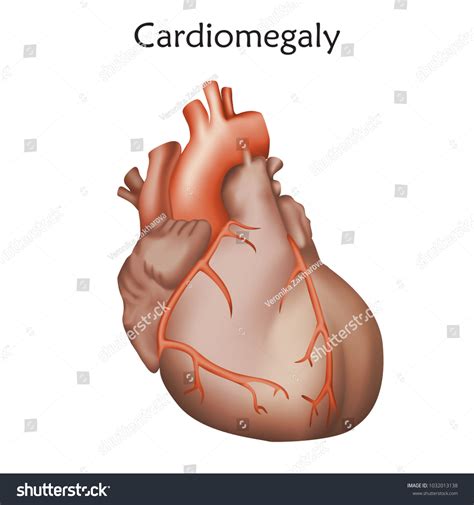 Cardiomegaly Enlarged Heart Muscle Anatomy Illustration Stock Vector
