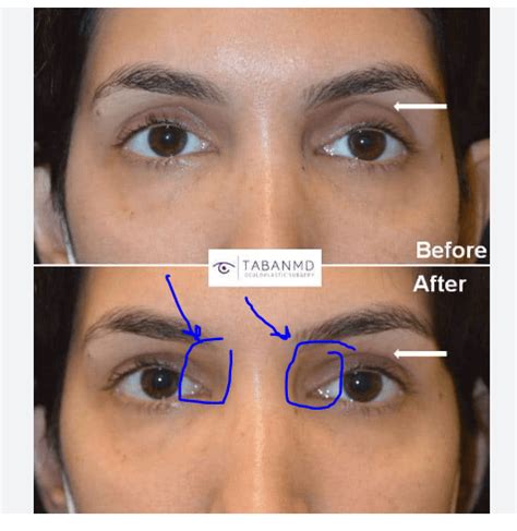 upper eyelid exposure : r/lookyourbest