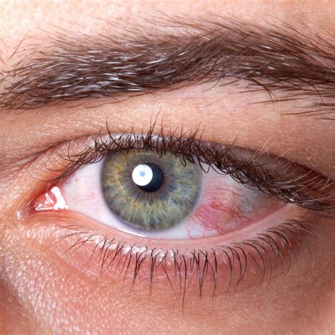 4 Ways You Can Tell if You Have an Eye Infection - Crescent Eye Care