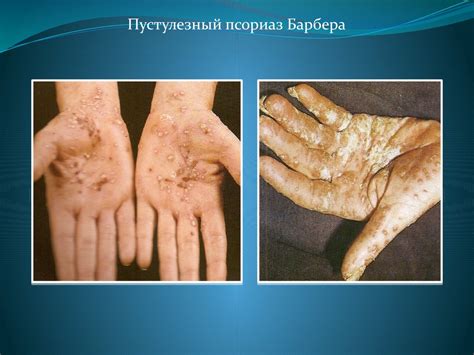 Псориаз. Красный плоский лишай - презентация онлайн