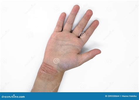 Allergy To the Hand of a Small Child Stock Photo - Image of healthcare ...