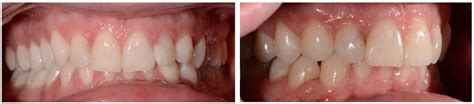 Фото зубів до і після встановлення елайнерів | Soloaligners