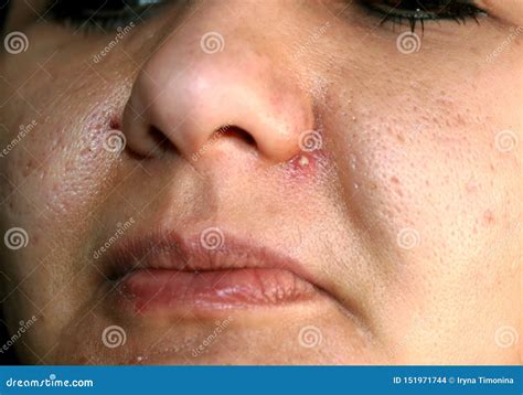 Inflamed Skin of the Face. Acne. Pimple Purulent on the Nose. Stock ...