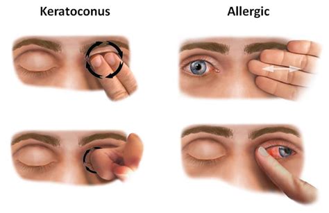 What is keratoconus eye disease? Treatments for keratoconus.