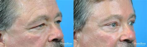 Blepharoplasty Before & After Gallery: Patient 19