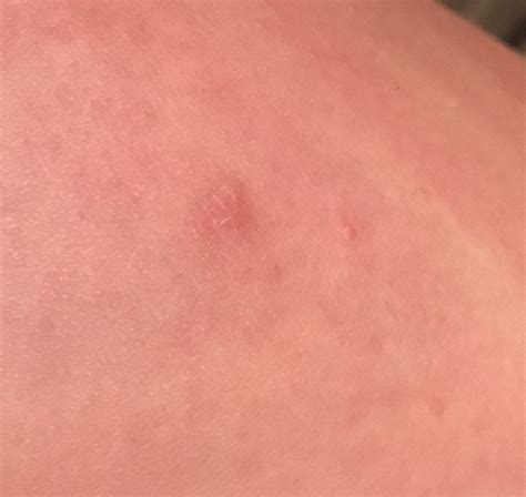 Possible bat bite? : Wildlife