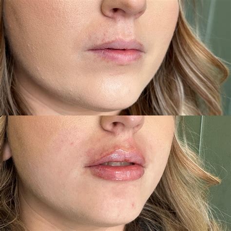 One syringe of filler in lips. : r/cosmeticsurgery