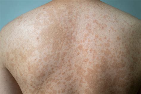 Tinea Versicolor | Treatment and Causes | Pictures