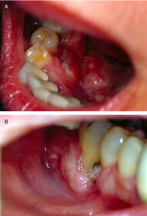 Langerhans Cell Histiocytosis Jaw